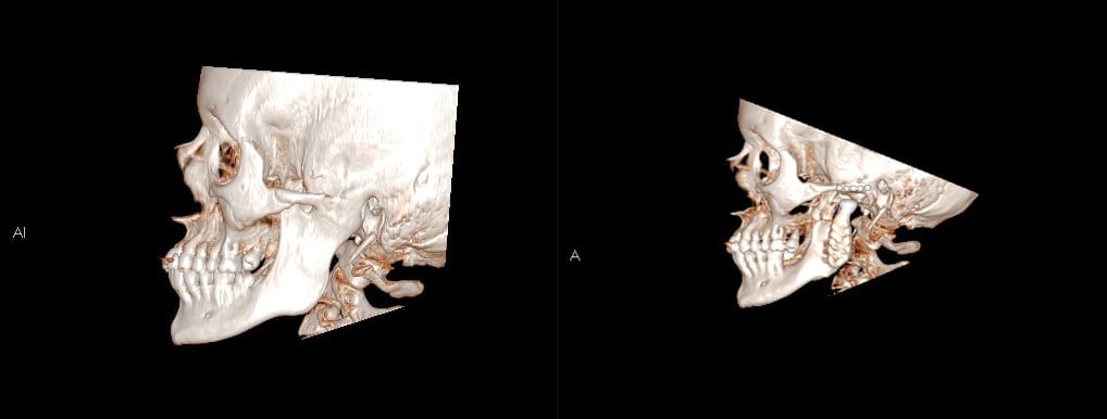 Tack vare en käkledsprotes har en patients gapförmåga ökat från 0 till 30 mm. Bilderna är tagna med datortomografi (DT), den till höger togs 4 år efter operationen. Eftersom materialet polyeten inte är röntgenkontrasterande syns inte ledpannan. I underkäken syns så kallade metallartefakter (effekter av mindre störningar från metall) utanpå delen som sitter på underkäken.