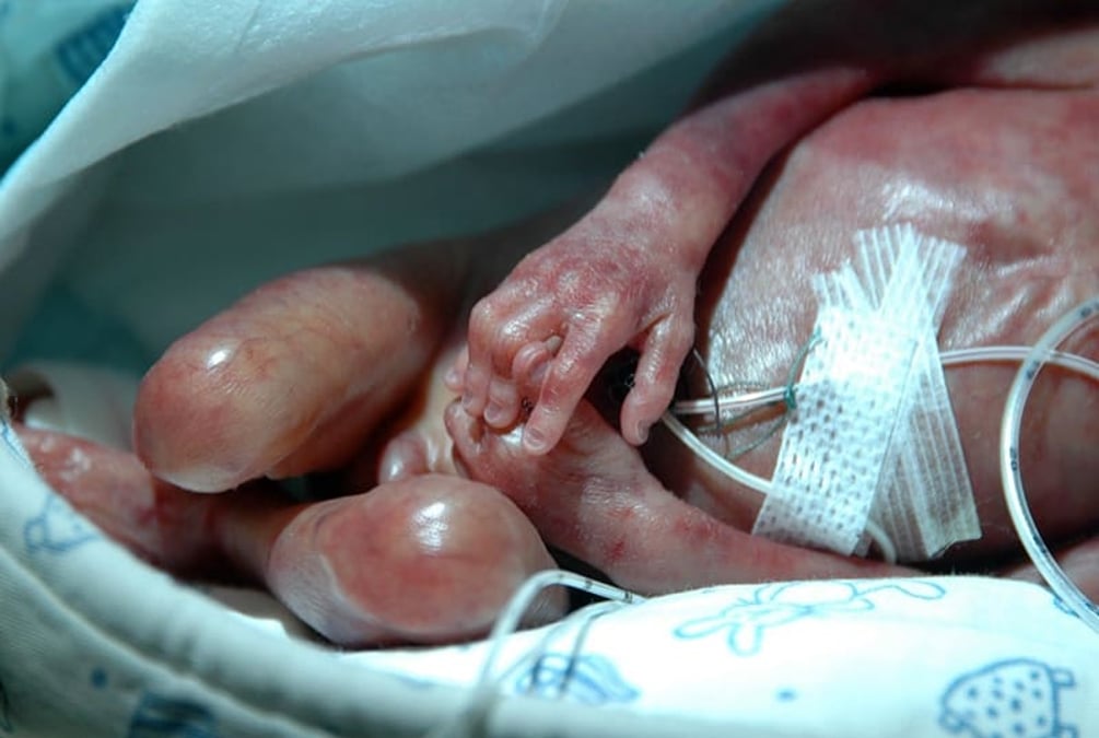 Den typ av svåra mag-tarmproblem som hanteras på Barngastrocentrum, till exempel kort tarmsyndrom, är vanligare hos prematurt födda barn.