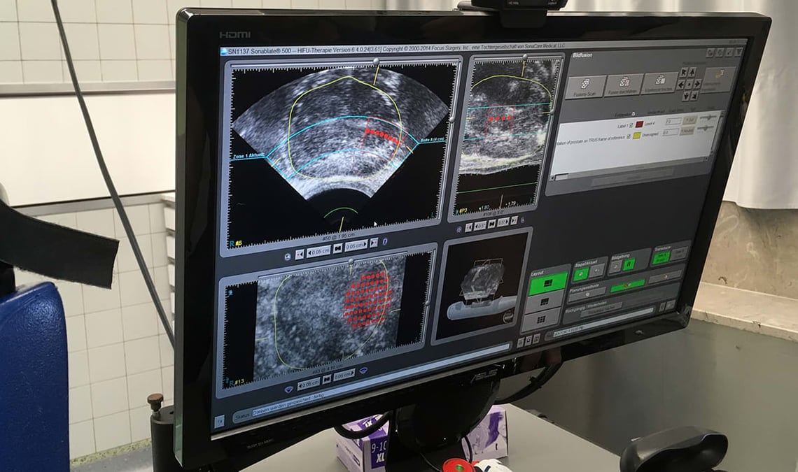 Vid HIFU-behandling bränns tumörvävnad i prostata bort med lokalt fokuserat ultraljud. Skärmen visar röda behandlingspunkter under pågående behandling.