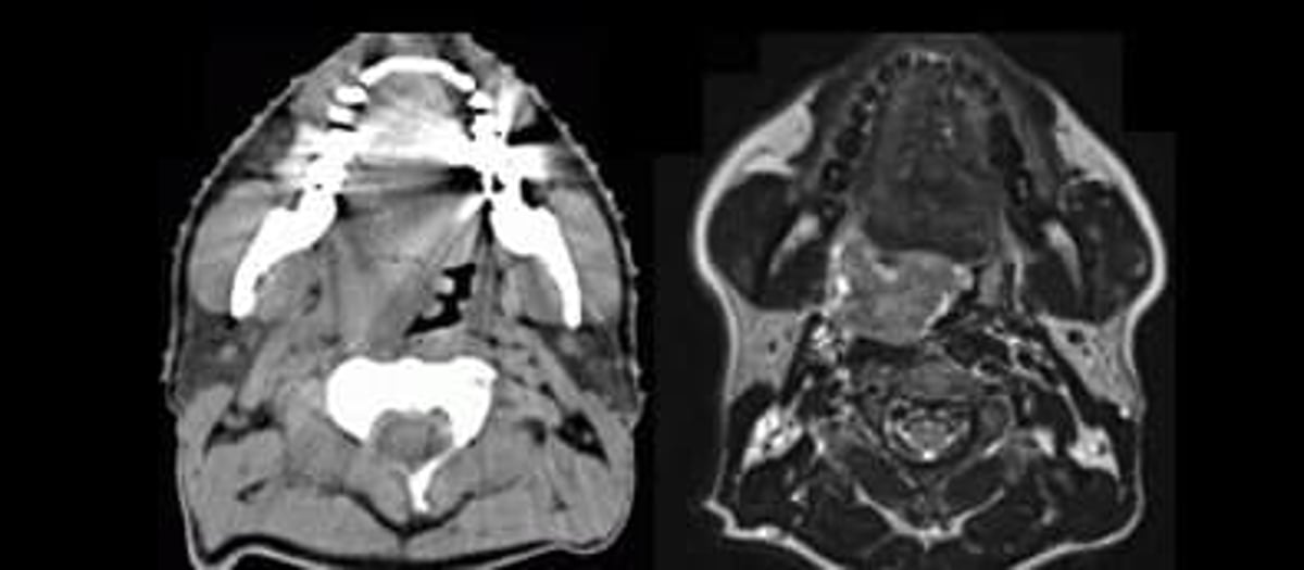 Till vänster röntgenbild med datortomografi (DT) i höjd med munhålan, till höger motsvarande bild av samma patient med magnetresonanstomografi, MRI, med tydligt förbättrad mjukdelskontrast.