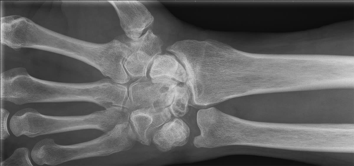 Röntgenbilden visar en handled som är totalförstörd på grund av avsaknad av brosk. Tack vare operationsmetoden handledsdenervation slapp patienten stelopereras och är idag smärtfri.