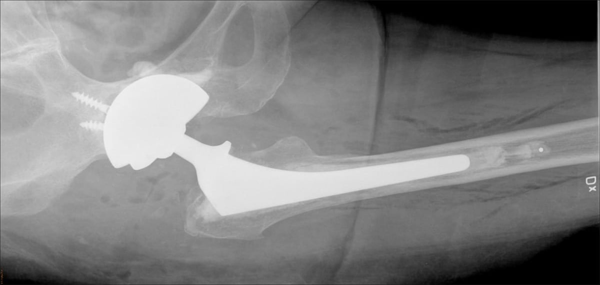Vid omoperation av höftproteser kan risken för instabilitet minska med en metod där man cementerar fast dubbelskålar i en större metallskål, CMC-metoden.