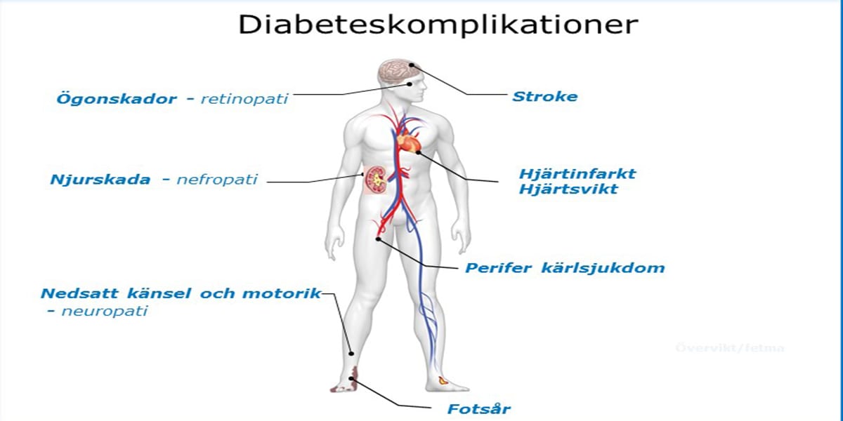 Illustrationen visar olika komplikationer som förekommer vid diabetes.