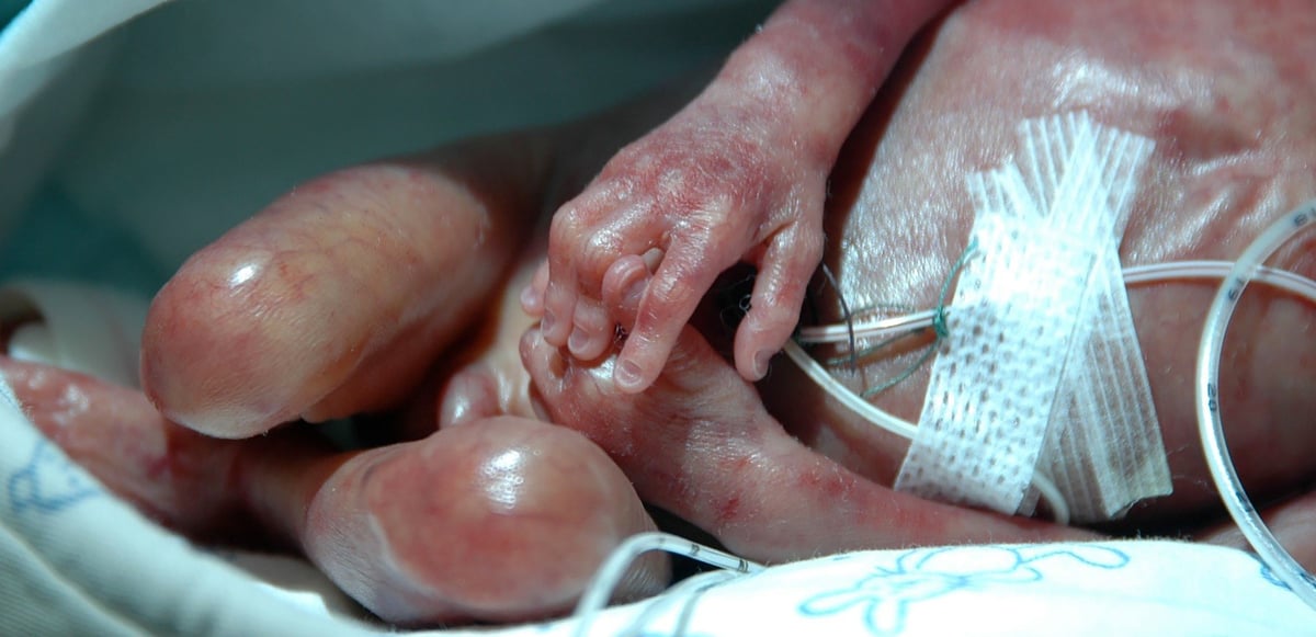 Barn som föds med kort tarmsyndrom  vårdas ofta inom neonatal intensivvård. Sjukdomen medför kronisk tarmsvikt som kräver långsiktig tarmrehabilitering i samarbete mellan föräldrar, hemsjukhus och Barngastrocentrum Uppsala. Foto: Akademiska sjukhuset