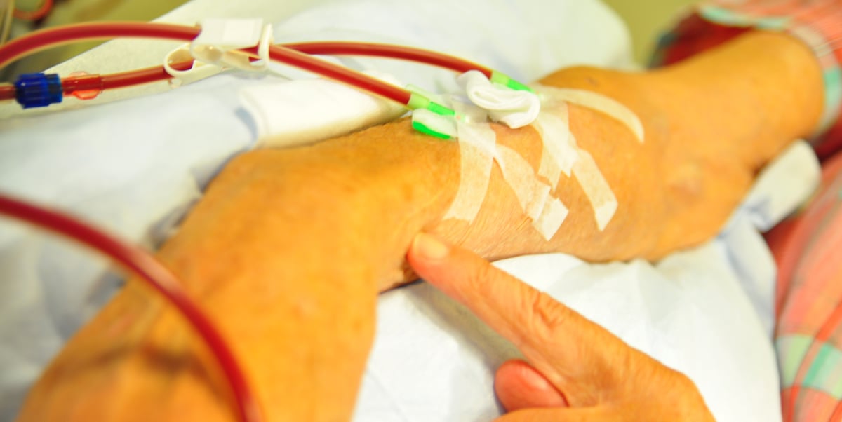 Vissa personer med avancerad kronisk njursvikt har behov av dialys eller njurtransplantation. I en ny studie vid bland annat Akademiska sjukhuset ska man utvärdera om/när patienter med avancerad njursvikt och förmaksflimmer ska rekommenderas behandling med blodförtunnande läkemedel. Idag saknas tillräcklig kunskap om detta. Fotograf: Christian Farman