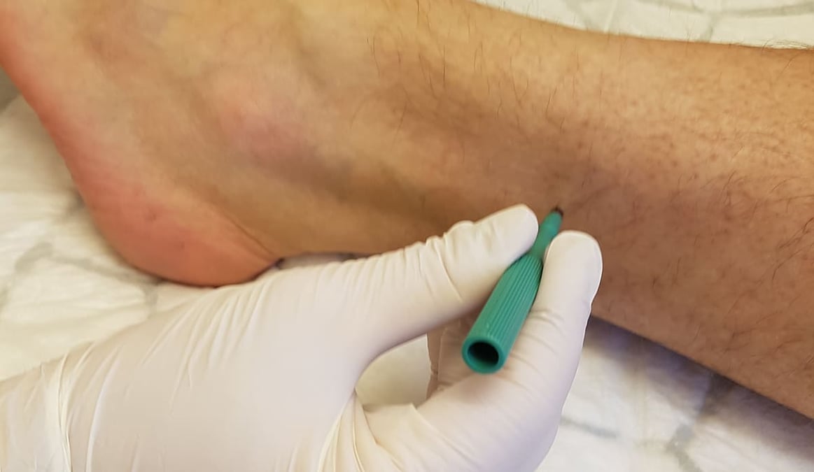 Via hudbiopsier vill forskare på Akademiska sjukhuset studera förekomsten av ett specifikt, skadligt protein (alfa-synuklein), en tidig markör för Parkinsons sjukdom. Målet är att kunna ställa diagnos och behandla sjukdomen tidigare än idag.