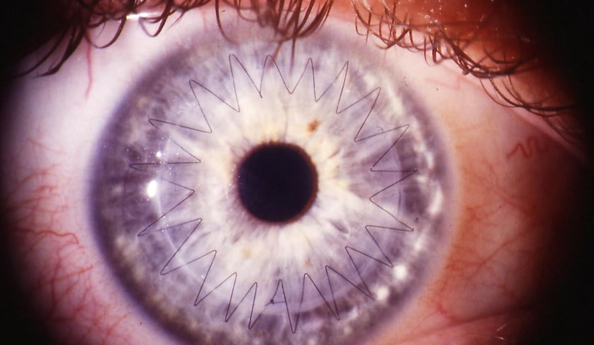 Hornhinnor är ett exempel på vävnader som tillvaratas på en speciell avdelning för vävnadsdonationer på Akademiska. 2017 hade sjukhuset 35 vävnadsdonatorer som donerade en eller flera vävnader.