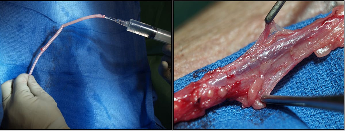 Vid kranskärlsoperationer används kroppsegna kärl som kopplas in bortom förträngningen eller stoppet. Till vänster syns en ven uttagen med standardteknik, till höger en ven uttagen med så kallad no-touch-teknik.