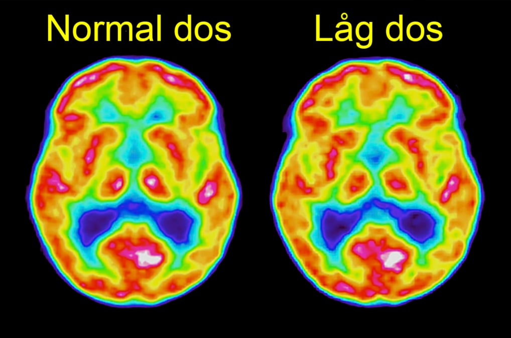 PET-avbildning av en frisk försöksperson med normal respektive hög dos.