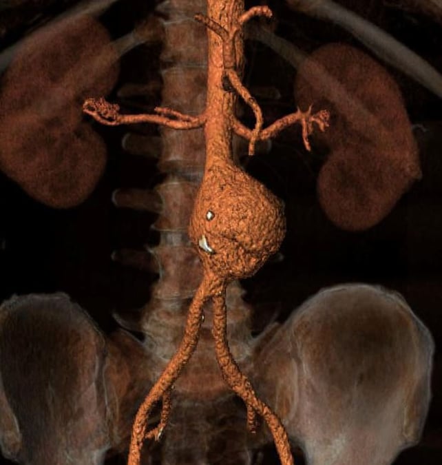 Aortaenrurysm (pulsåderbråck) är ett allvarlig, ofta livshotande tillstånd som oftast drabbar äldre män.