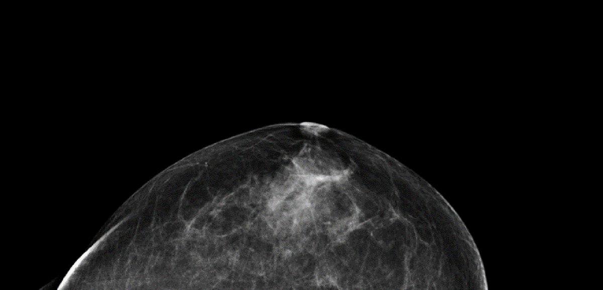 Enligt en utvärdering från Socialstyrelsen minskar mammografi dödligheten i cancer med 16 procent i åldersgruppen 40-49 år och drygt 20 procent i guppen 50–74 år. Röntgenbilden visar ett bröst utan cancer fotograferat uppifrån. De mörka partierna är fettvävnad och de vita kärl- och bindvävnad.