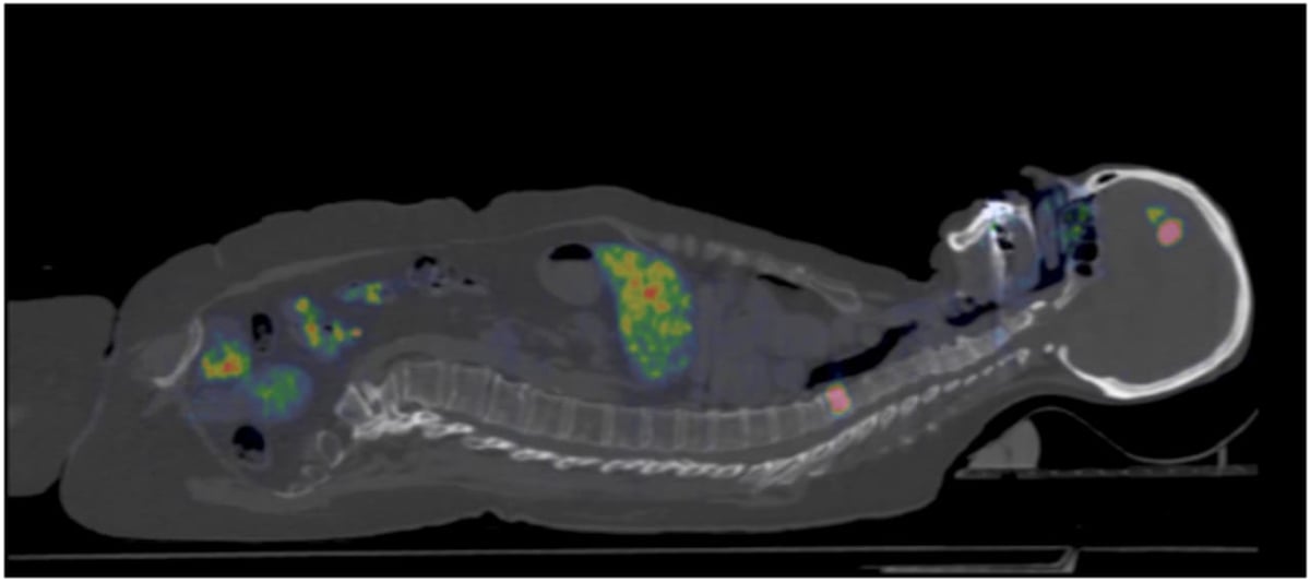 Effektivare diagnostik av bröstcancer utan biopsier är målet för en nordisk studie ledd från Akademiska. Forskarna använder pet-kamera och ett nytt spårämne.