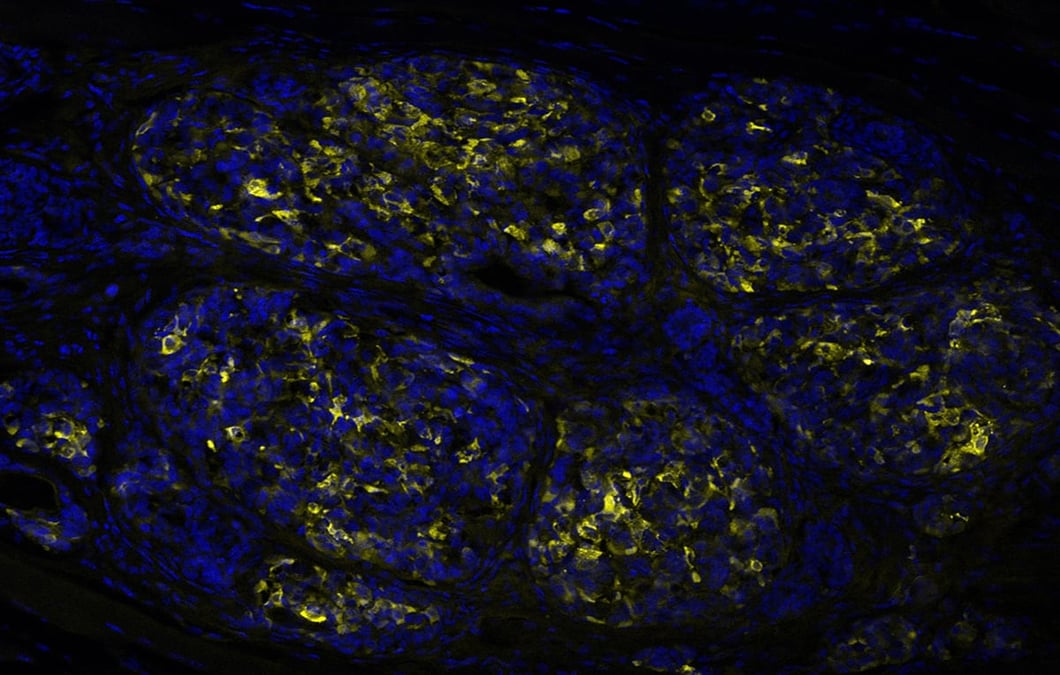 Insulinproducerande celler framodlade ur stamceller, experimentellt transplanterade till en muskel. Insulin ses i gult och cellkärnor i blått.