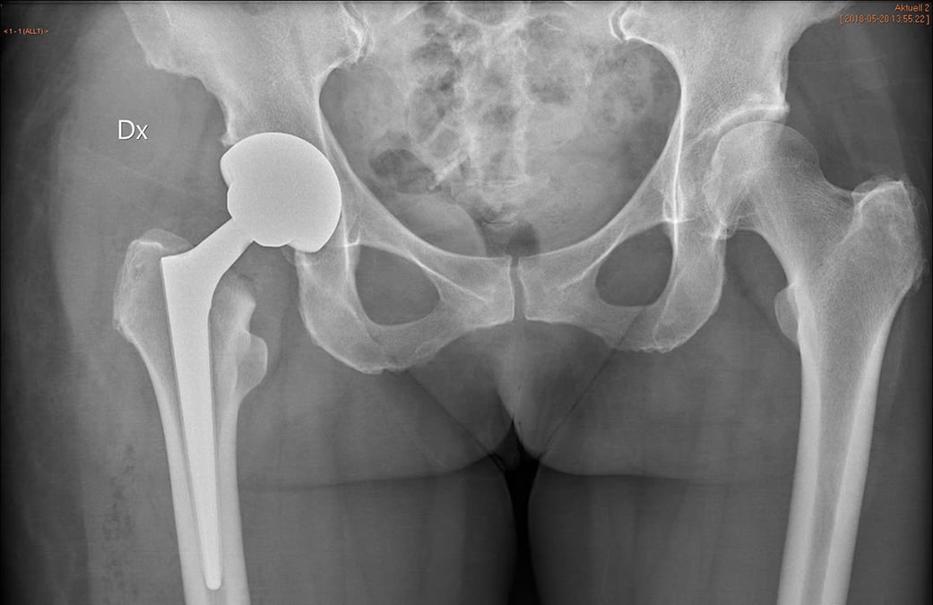 Röntgenbilden visar ett bäcken där patienten på ena sidan (vänster i bild) fått en höftprotes inopererad.
