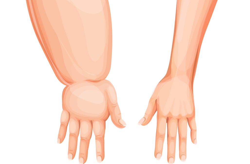 Lymfödem innebär att lymfvätska ansamlas i vävnaden på grund av ett skadat lymfsystem. Vanligast är lymfödem i en arm eller ben efter cancerbehandling eller annat trauma. Vid komplexa lymfödem kan flera organ beröras och patienten behöva träffa flera specialister för att snabbt få rätt vård. Därför har Akademiska startat multidisciplinära ronder. Bild: Mostphotos