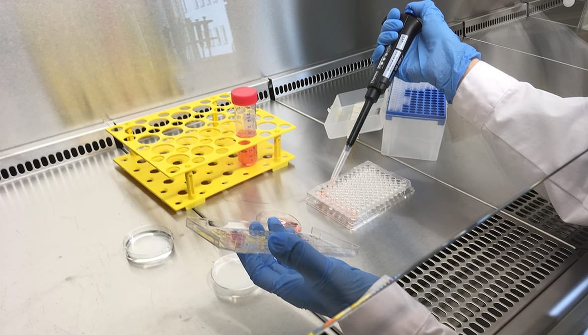 En ny diagnosmetod utvecklad av Uppsalaforskare gör det möjligt att redan vid diagnos förutsäga prognos och sjukdomsförlopp vid SLE. Detta förbättrar möjligheterna att anpassa behandlingen individuellt.