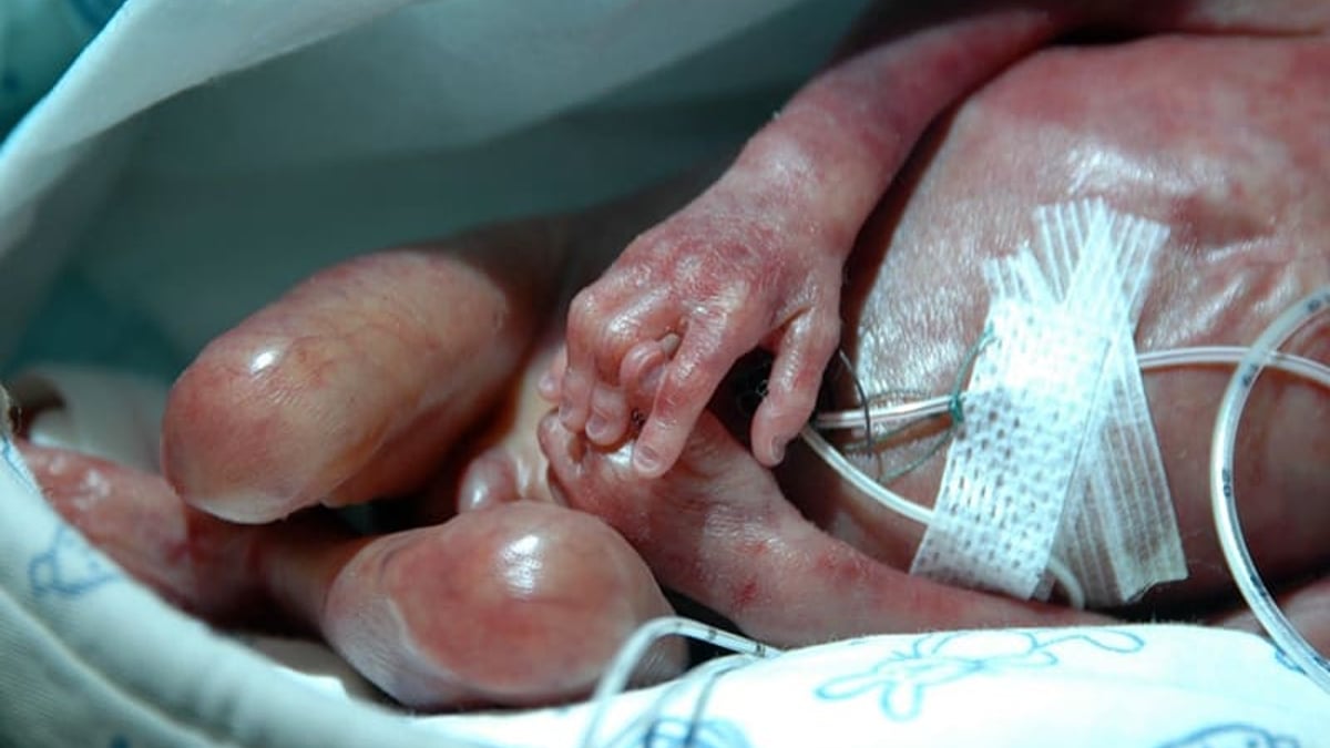 Den typ av svåra mag-tarmproblem som hanteras på Barngastrocentrum, till exempel kort tarmsyndrom, är vanligare hos prematurt födda barn.