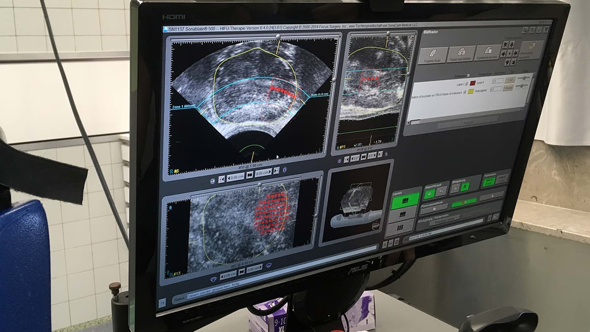 Vid HIFU-behandling bränns tumörvävnad i prostata bort med lokalt fokuserat ultraljud. Skärmen visar röda behandlingspunkter under pågående behandling.