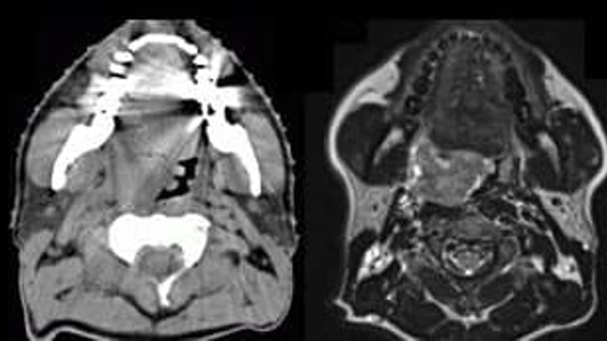 Till vänster röntgenbild med datortomografi (DT) i höjd med munhålan, till höger motsvarande bild av samma patient med magnetresonanstomografi, MRI, med tydligt förbättrad mjukdelskontrast.