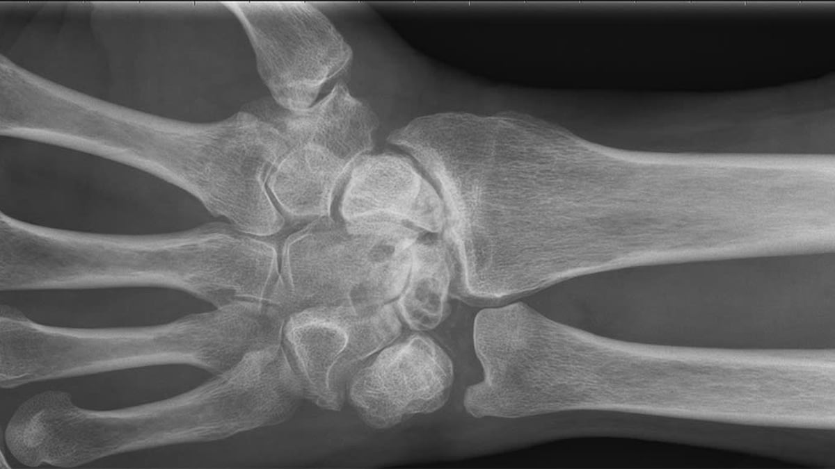 Röntgenbilden visar en handled som är totalförstörd på grund av avsaknad av brosk. Tack vare operationsmetoden handledsdenervation slapp patienten stelopereras och är idag smärtfri.