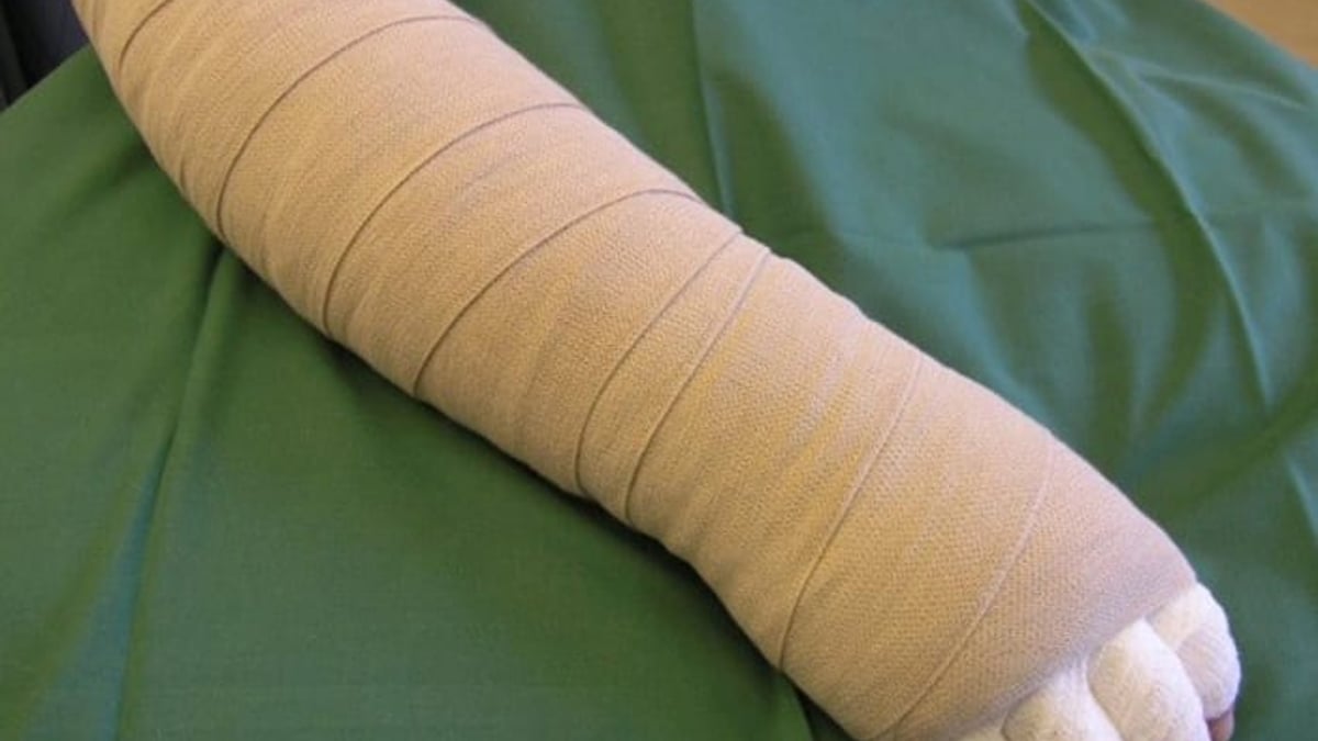 Förflyttning av lymfkörtlar kan bli en ny behandling mot lymfödem. Metoden prövas i en ny studie på Akademiska. Idag behandlas patienterna ofta med kompressionsstrumpa då hela armen täcks av lågelastiska lindor.