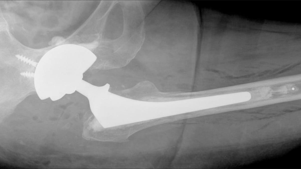 Vid omoperation av höftproteser kan risken för instabilitet minska med en metod där man cementerar fast dubbelskålar i en större metallskål, CMC-metoden.
