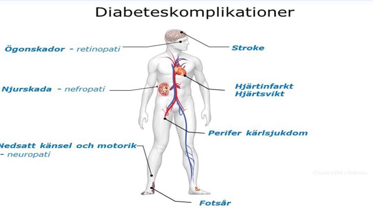 Illustrationen visar olika komplikationer som förekommer vid diabetes.