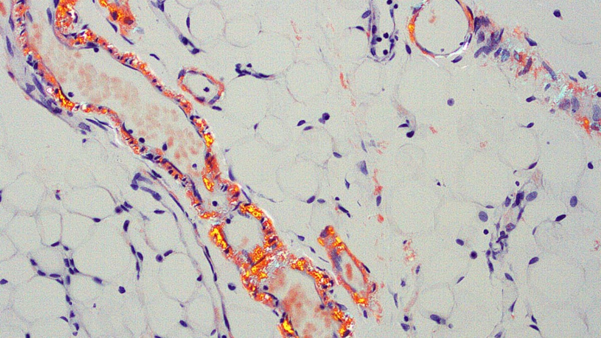 Systemisk amyloidos är ovanliga sjukdomar som beror på felveckade proteiner och ofta påverkar flera organ såsom hjärta och njure. På bilden, som är tagen i mikroskop, syns en amyloid inlagring (rödmarkerat) i vävnad.