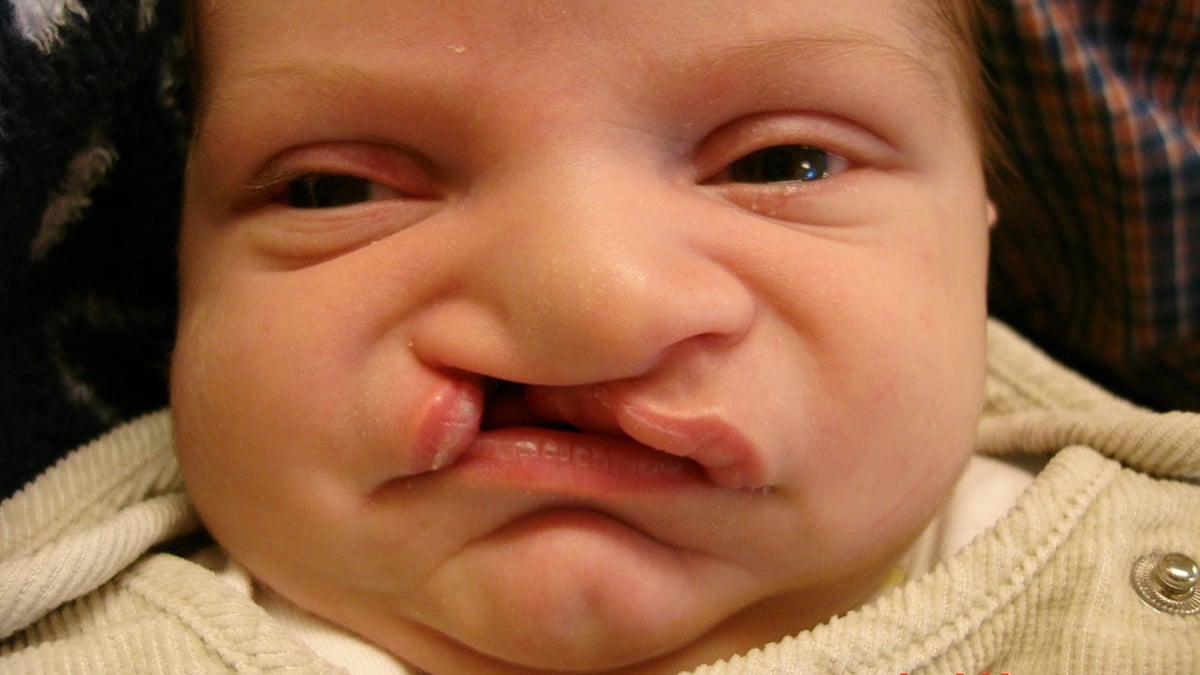 Barn som föds med läpp-käk-gomspalt löper ökad risk för språkstörning, autismspektrumstörning, ADHD, psykotiska sjukdomar med flera neuropsykiatriska funktionsnedsättningar. Det visar en registerstudie vid Uppsala universitet/Akademiska sjukhuset.