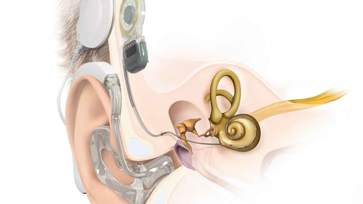 Hörselbevarande impantat (EAS) blir allt vanligare. Nio av tio patienter med svår hörselnedsättning har bevarad hörsel efter operationen.