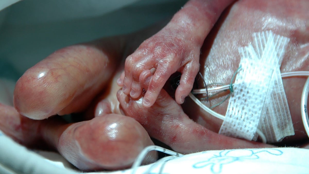 Barn som föds med kort tarmsyndrom  vårdas ofta inom neonatal intensivvård. Sjukdomen medför kronisk tarmsvikt som kräver långsiktig tarmrehabilitering i samarbete mellan föräldrar, hemsjukhus och Barngastrocentrum Uppsala. Foto: Akademiska sjukhuset