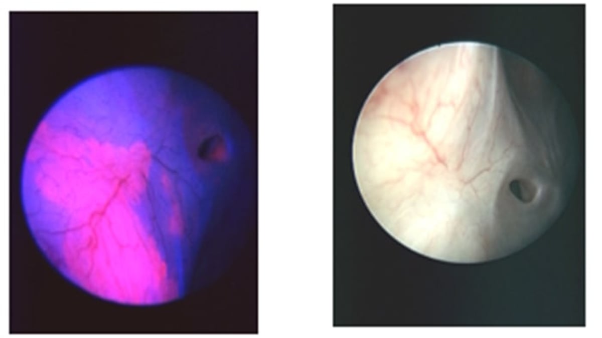 Med en fotodynamisk metod kan urinblåscancer upptäckas och behandlas effektivare på Akademiska. Cancercellerna återreflekteras i rött (vänster).