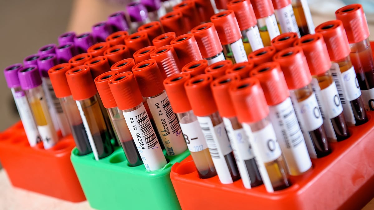 Forskare på Akademiska sjukhuset har i en studie funnit att två biomarkörer i blodet är vanligare hos svårt sjuka covidpatienter som utvecklar muskelsvaghet under intensivvård. Detta kan leda till att förebyggande behandling kan sättas in tidigare.