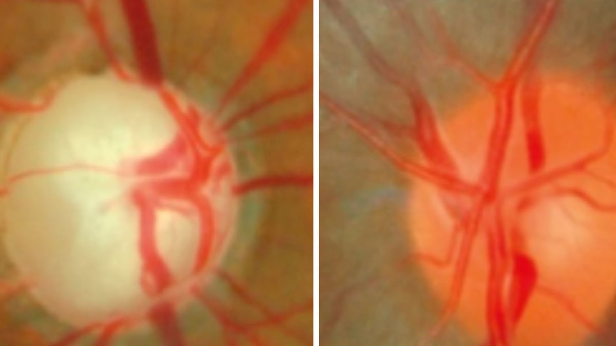 Till vänster: Höger synnerv i öga hos patient med glaukom. Till höger: Vänster synnerv i normalt öga. Den gulbleka färgen i höger öga beror på att nerver som överför information från ögat till hjärnan saknas. Foto: Akademiska sjukhuset