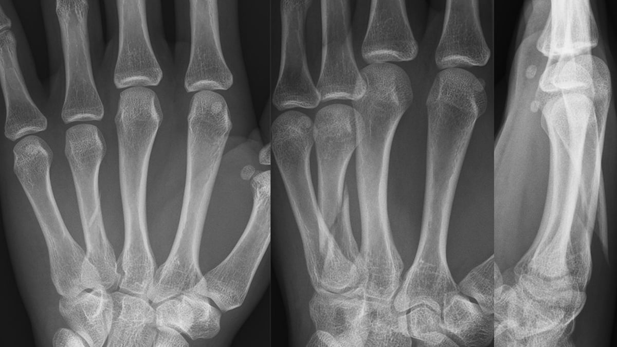 En forskningsstudie ledd från Akademiska visar att en ny behandlingsmetod för frakturer på mellanhandsbenen, fokuserad på aktiv träning, ger lika bra resultat som traditionell behandling med operation och gipsning.
