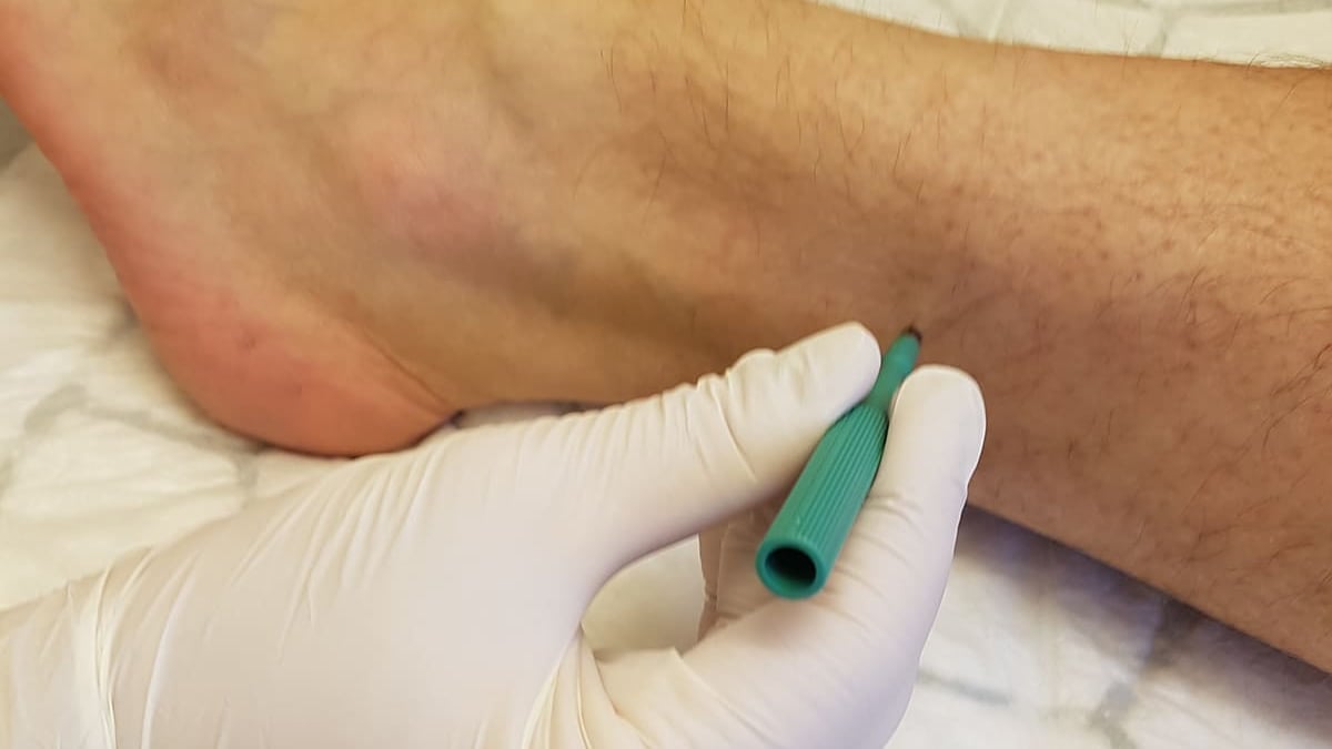 Via hudbiopsier vill forskare på Akademiska sjukhuset studera förekomsten av ett specifikt, skadligt protein (alfa-synuklein), en tidig markör för Parkinsons sjukdom. Målet är att kunna ställa diagnos och behandla sjukdomen tidigare än idag.