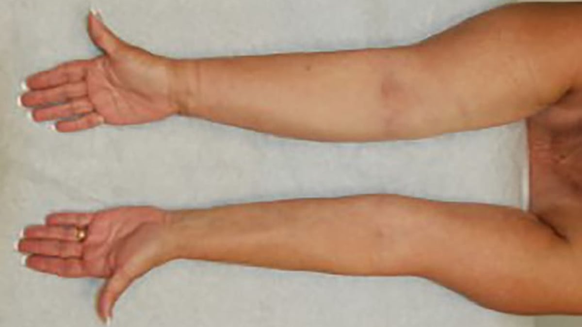 Lymfödem innebär att lymfvätska ansamlas i vävnaden på grund av ett skadat lymfsystem, exempelvis efter bröstcancerbehandling (höger arm på bilden).