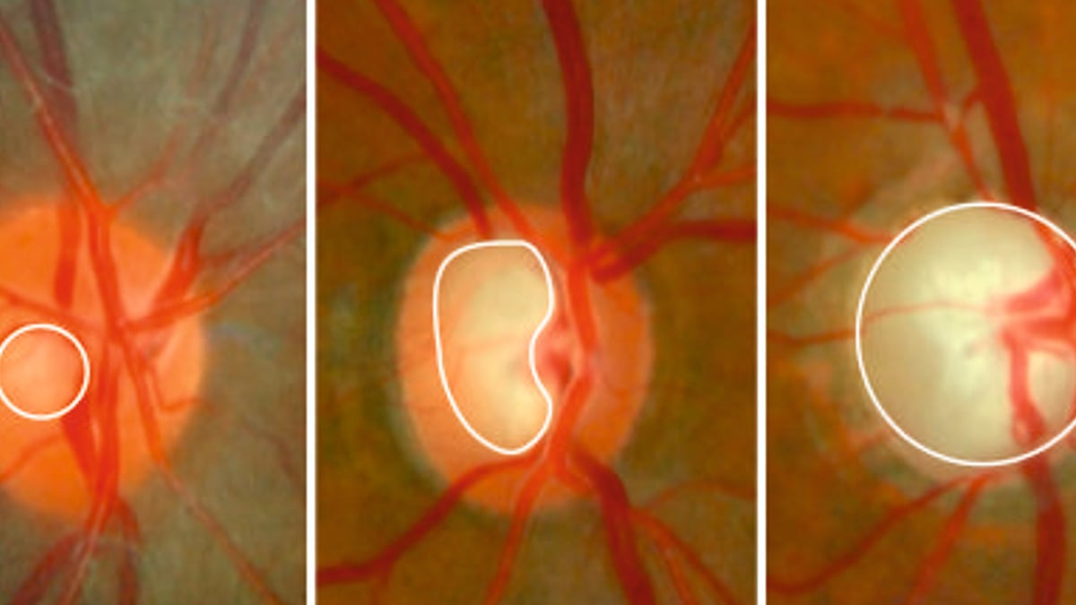 Vid glaukom kan det uppstå en förlust av nervtrådar (kablar från näthinnan till hjärnan). Till vänster: Bild på ett öga utan glaukom. Avståndet är stort mellan inre begränsningen av nervtrådar (markerat med vit ring) och synnervshuvudets yttre begränsning. I mitten: Pågående sjukdom där nervfibrer har försvunnit så att avståndet mellan den vita ringen och periferin har reducerats. Höger: Slutstadium glaukom. Nästan alla nervfibrer har försvunnit så att avståndet mellan den vita ringen och synnervshuvudets yttre begränsning nästan är utraderat.