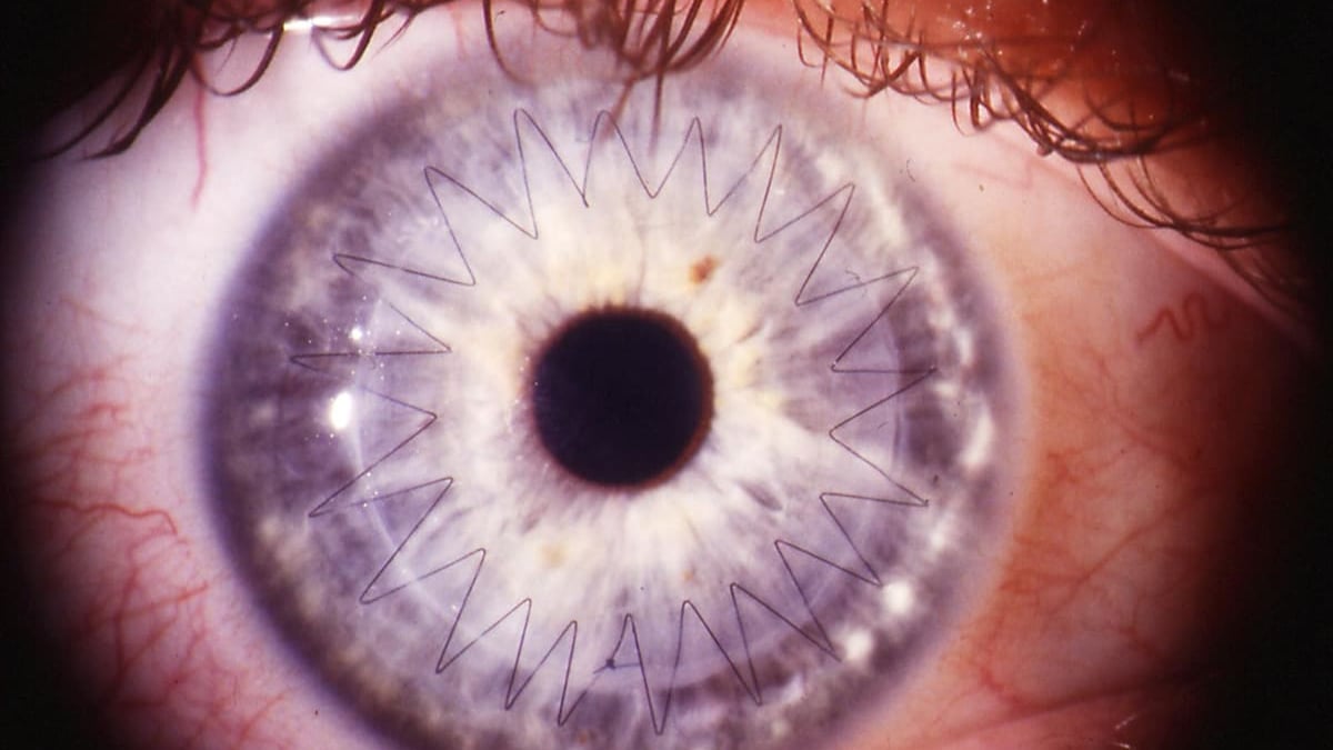 Hornhinnor är ett exempel på vävnader som tillvaratas på en speciell avdelning för vävnadsdonationer på Akademiska. 2017 hade sjukhuset 35 vävnadsdonatorer som donerade en eller flera vävnader.