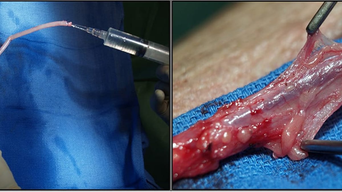 Vid kranskärlsoperationer används kroppsegna kärl som kopplas in bortom förträngningen eller stoppet. Till vänster syns en ven uttagen med standardteknik, till höger en ven uttagen med så kallad no-touch-teknik.