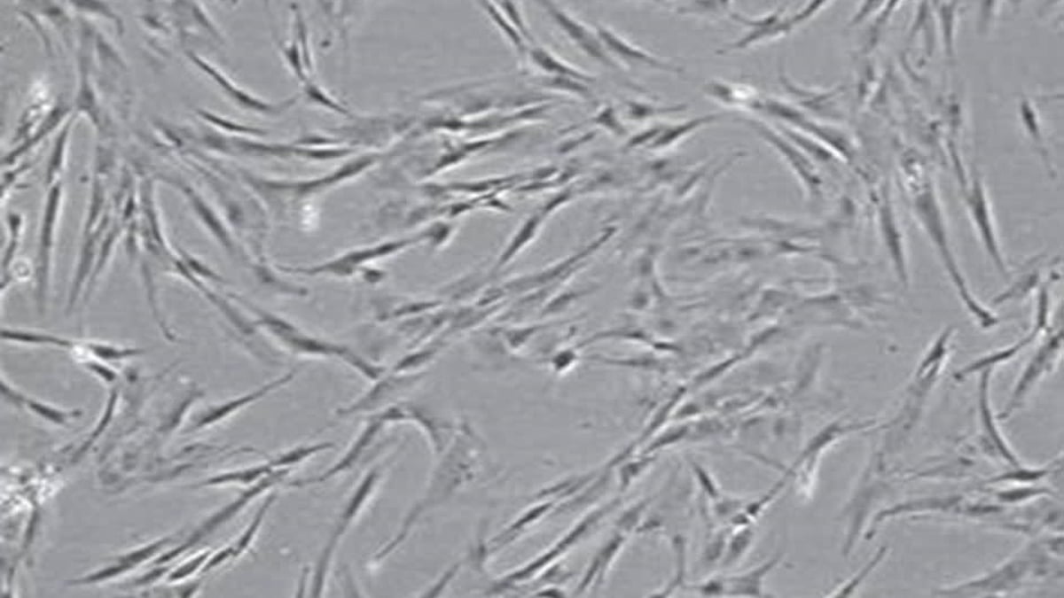 I en ny nordisk studie, ledd från Akademiska sjukhuset, ska patienter med akut livshotande transplantat-mot-värd reaktion, så kallad GVHD, behandlas med moderkaksceller för att stoppa avstötningsreaktionen.