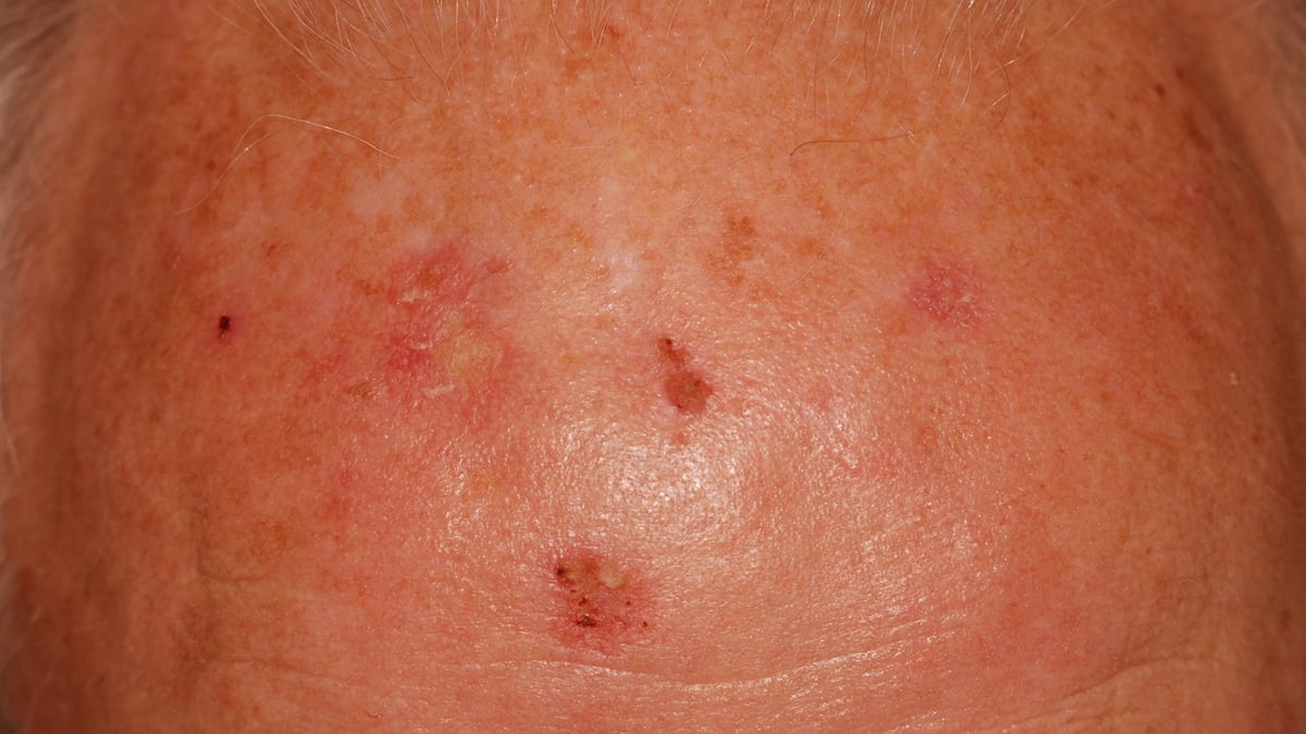 Nu permanentas drop-in-mottagningen på Akademiska för behandling med dagsljus-PDT. Målgruppen är patienter med så kallade aktiniska keratoser, milda och måttliga solskador som kan utvecklas till skivepitelcancer.