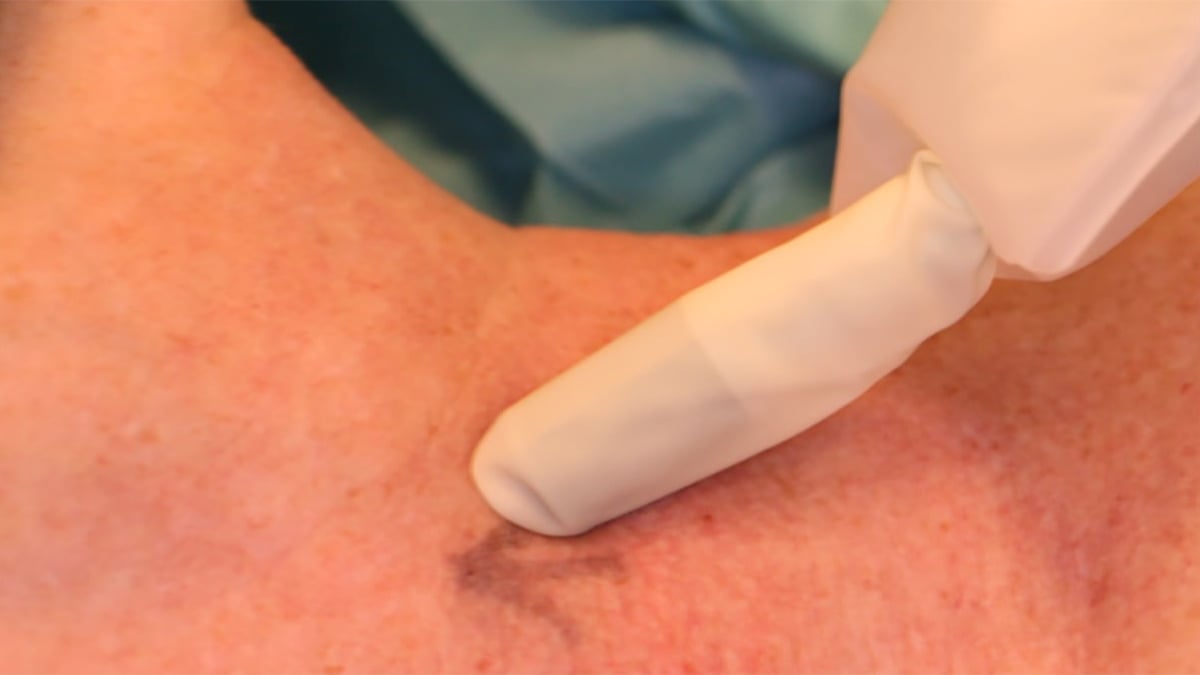 Sentinel node/portvaktskörtelbiopsi är en ny metod för behandling av munhålecancer.