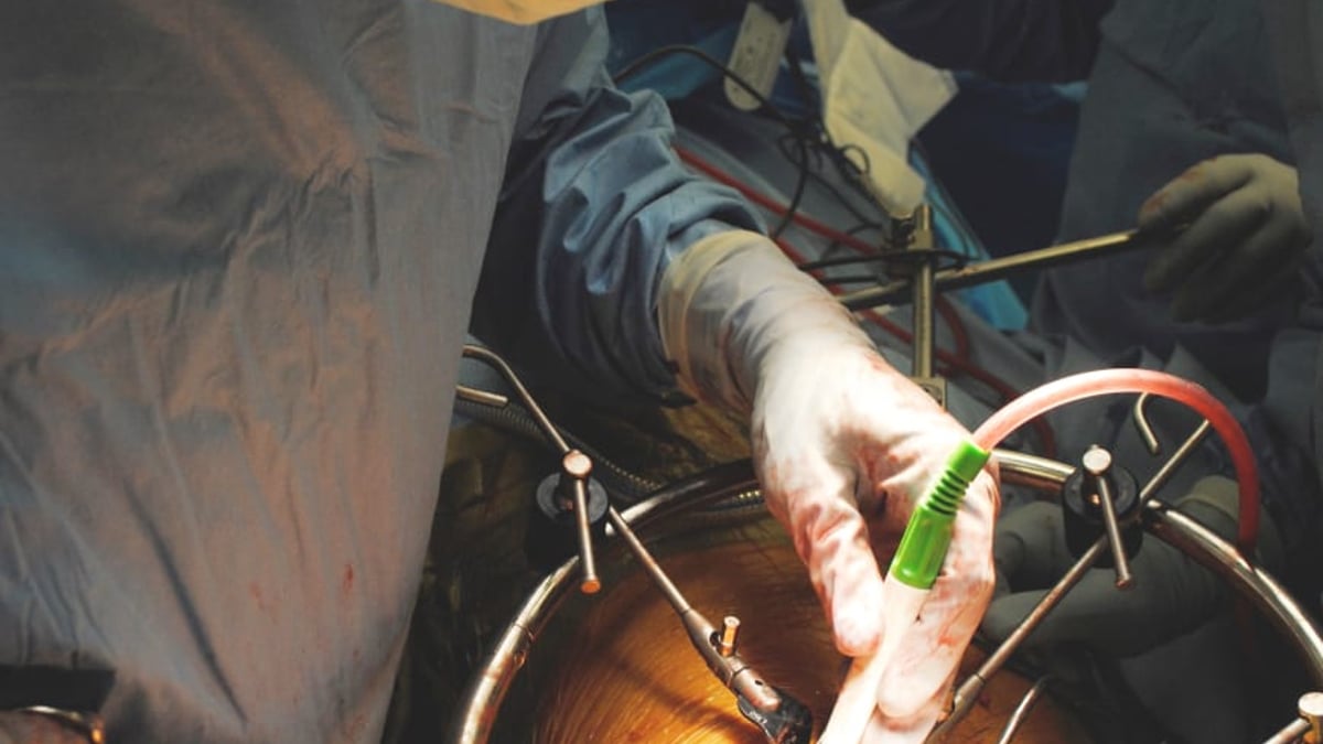 Yohan Robinson, ryggkirurg på Akademiska sjukhuset, opererar en kotpelartumör genom bröstkorgen (Foto: Yohan Robinson)