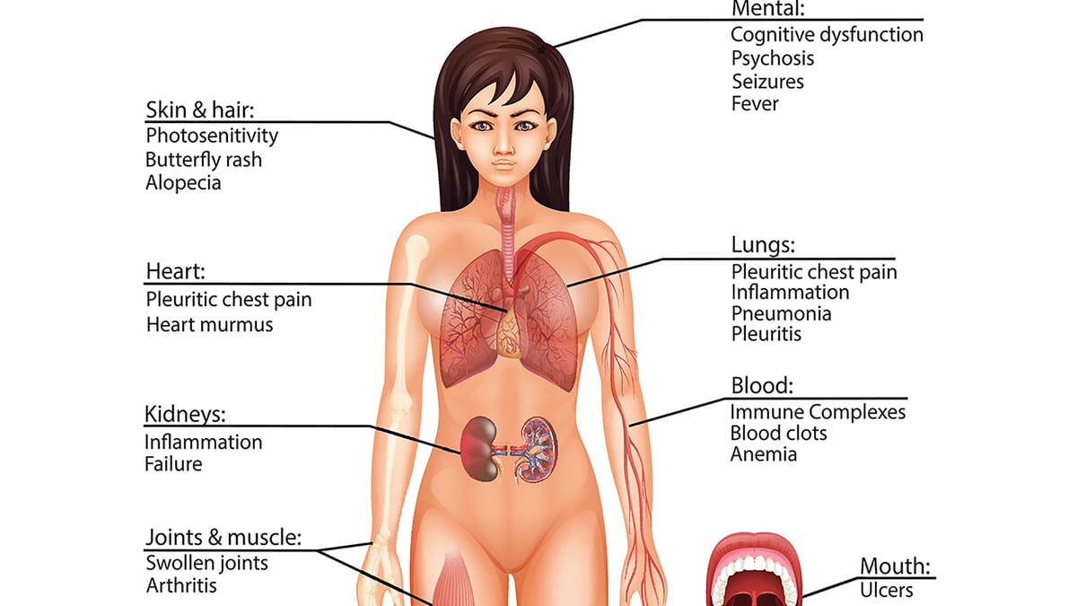 För första gången sedan 2011 har två nya läkemedel i år registrerats mot SLE i Sverige. Detta ses som ett genombrott i behandlingen av den kroniska, reumatiska systemsjukdomen. (Illustration: Mostphotos)