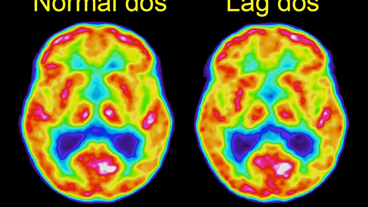 PET-avbildning av en frisk försöksperson med normal respektive hög dos.