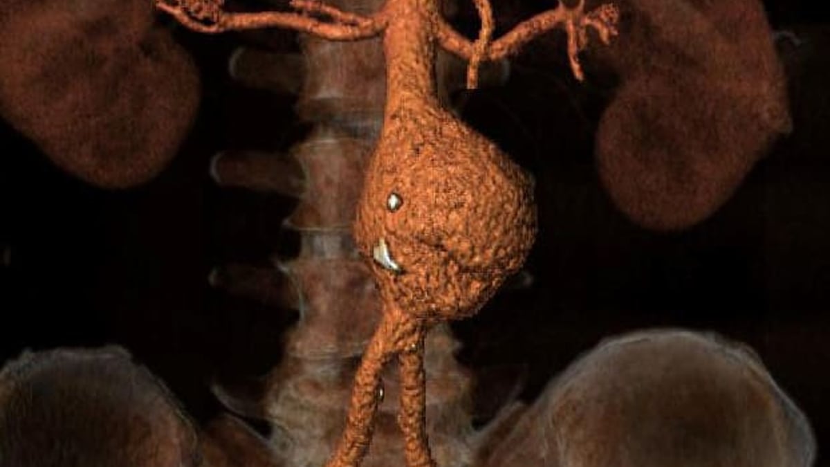 Aortaenrurysm (pulsåderbråck) är ett allvarlig, ofta livshotande tillstånd som oftast drabbar äldre män.
