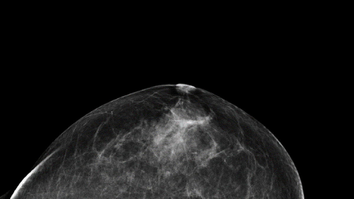 Enligt en utvärdering från Socialstyrelsen minskar mammografi dödligheten i cancer med 16 procent i åldersgruppen 40-49 år och drygt 20 procent i guppen 50–74 år. Röntgenbilden visar ett bröst utan cancer fotograferat uppifrån. De mörka partierna är fettvävnad och de vita kärl- och bindvävnad.