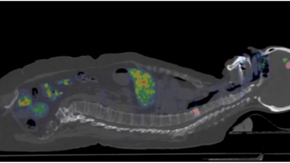 Effektivare diagnostik av bröstcancer utan biopsier är målet för en nordisk studie ledd från Akademiska. Forskarna använder pet-kamera och ett nytt spårämne.