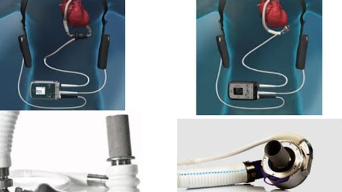 På Akademiska sjukhuset används två typer av batteridrivna hjärtpumpar, så kallade Left Ventricular Assist Devices (LVADs). Den senaste generationens pump (höger) är så liten att den ryms i hjärtsäcken.